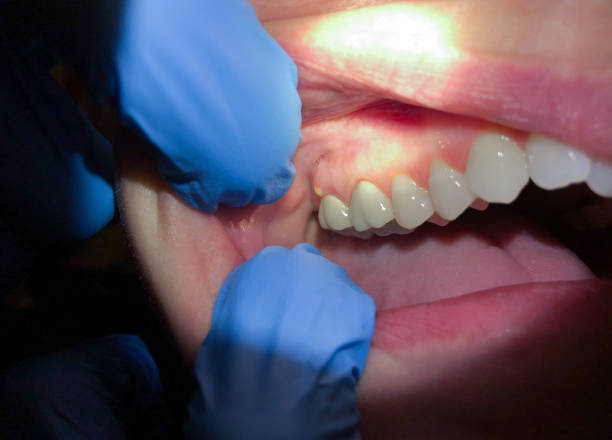Best Emergency Dental Care for Broken or Chipped Teeth in Spanish Springs, NV